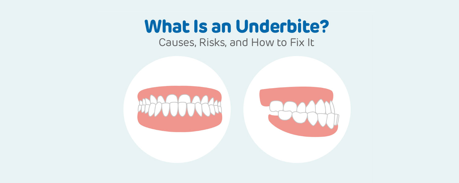 What Is an Underbite? Causes, Risks, and How to Fix It