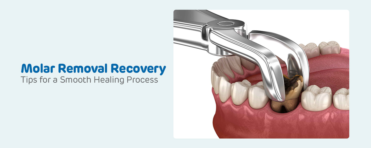 Molar Removal Recovery: Tips for a Smooth Healing Process